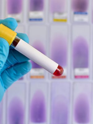 exame-de-sangue-laboratorio-de-analises-clinicas-tubo-de-ensaio-tipo-sanguineo-1476735344347_v2_1920x1280