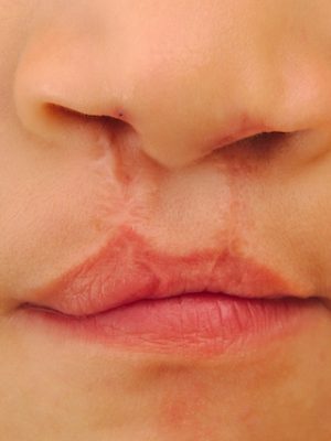 cirurgia-para-labio-leporino-e-fenda-palatina_24839_l