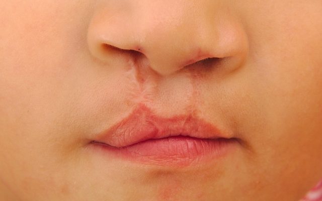 cirurgia-para-labio-leporino-e-fenda-palatina_24839_l