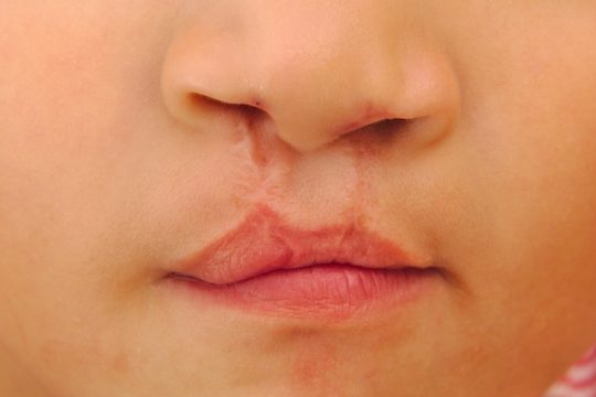 cirurgia-para-labio-leporino-e-fenda-palatina_24839_l